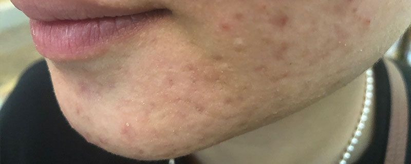 牙膏涂脸上有什么作用