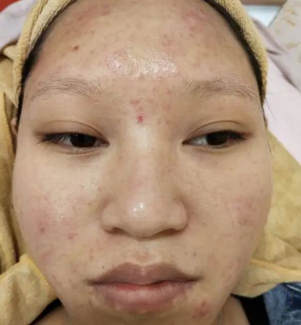 油皮夏天不好混「学会7个护肤技巧 清爽舒适轻松拥有」  油皮 护肤 第1张