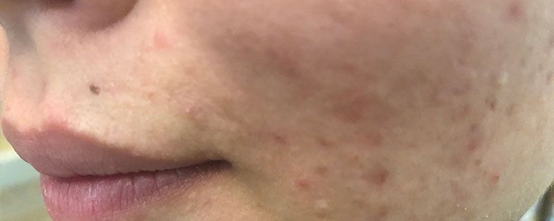 复方肝素钠尿囊素凝胶有激素吗  尿囊素 第2张