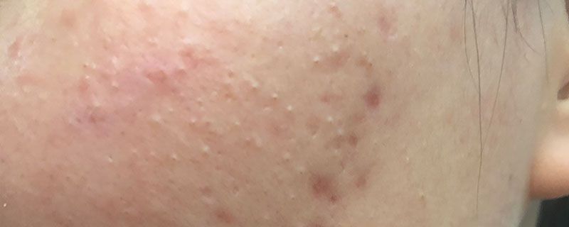 复方肝素钠能去痘印吗 皮肤 第2张 复方肝素钠能去痘印吗 皮肤 第2张