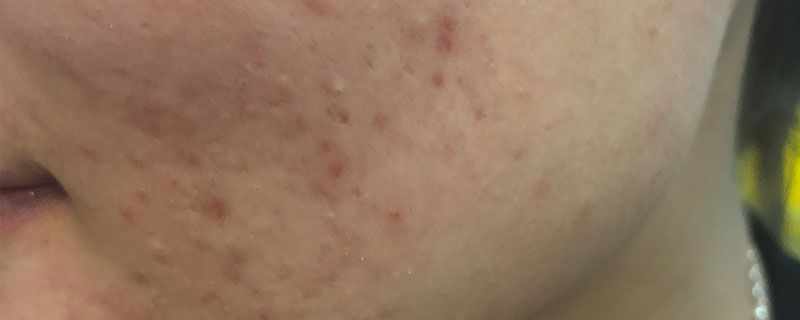 牙膏抹痘痘  牙膏 第2张