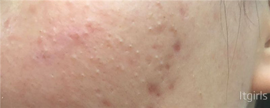 怎样简单的消除痘痘