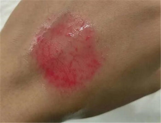 卸妆油怎么用才不会闷痘，卸妆油正确用法分析  卸妆油 彩妆 第3张