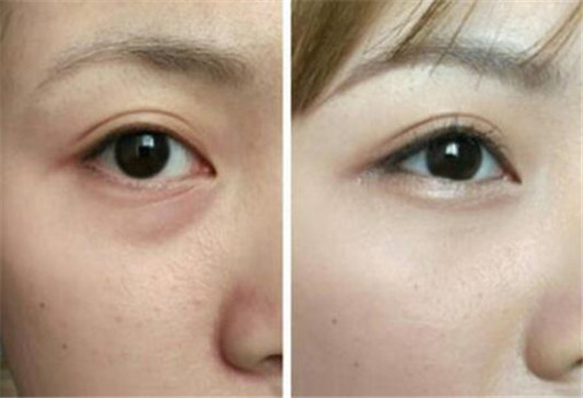 遮瑕膏如何遮眼袋，什么颜色合适