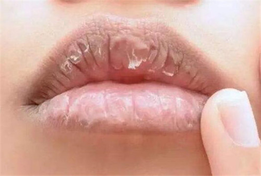 一涂口红就脱皮怎么办 几个小妙招解决