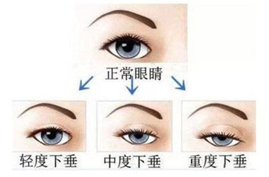 经常贴双眼皮贴的危害这么多 你还贴吗 贴双眼皮 危害 彩妆 第2张 经常贴双眼皮贴的危害这么多 你还贴吗 贴双眼皮 危害 彩妆 第2张