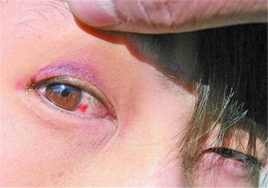 经常贴双眼皮贴的危害这么多 你还贴吗 贴双眼皮 危害 彩妆 第3张 经常贴双眼皮贴的危害这么多 你还贴吗 贴双眼皮 危害 彩妆 第3张