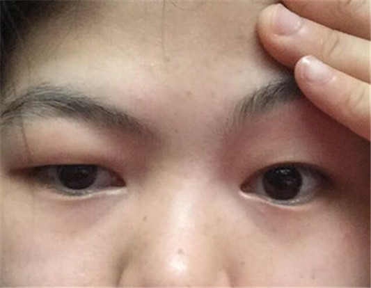 厚眼皮怎么变薄小窍门有哪些 可以尝试这几个