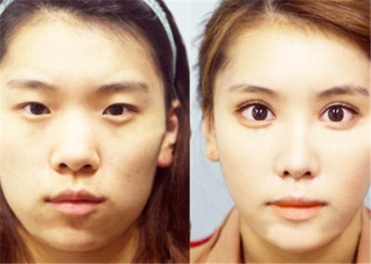 不能做双眼皮的眼睛图都有哪些