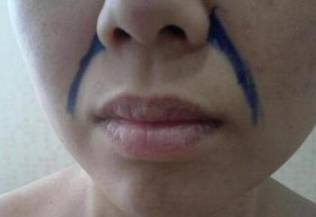 白醋加牙膏祛法令纹需要敷多长时间，有效吗