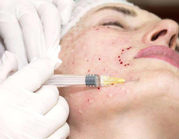 胶原蛋白除皱大概要多少钱  胶原蛋白 除皱 多少钱 抗皱护肤 第3张