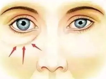 36岁泪沟皱纹怎么办，去除泪沟纹小方法  抗皱护肤 第2张