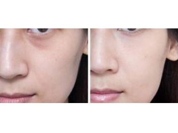 36岁泪沟皱纹怎么办，去除泪沟纹小方法  抗皱护肤 第3张