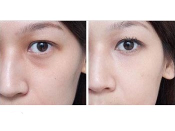 36岁泪沟皱纹怎么办，去除泪沟纹小方法  抗皱护肤 第4张