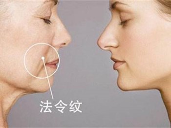 法令纹是如何形成的，成因及预防