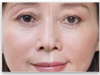 什么方法去除皱纹效果最好，五个实用方法  去除皱纹 效果 最好 抗皱护肤 第5张