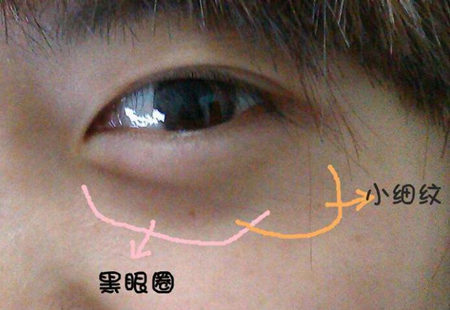 去眼睛下面小细纹偏方都有哪些，这些偏方靠谱吗