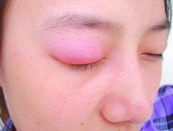 眼皮松弛做埋线的后果  眼皮松弛 美白祛黄 第6张