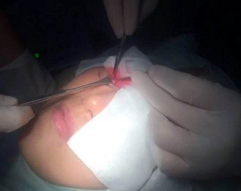 提眉手术可以保持几年，眉形改造必看  提眉手术 美白祛黄 第3张