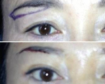 提眉手术可以保持几年，眉形改造必看  提眉手术 美白祛黄 第4张