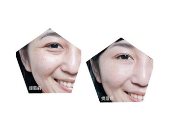 提眉手术可以保持几年，眉形改造必看  提眉手术 美白祛黄 第5张