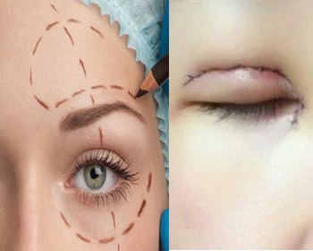 切眉和做双眼皮哪个好，眼部整形大对比