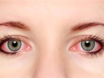 眼睛感染发炎怎么办，七大缓解方法