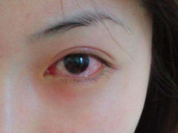 眼睛感染发炎怎么办，七大缓解方法  眼睛 怎么办 美白祛黄 第2张