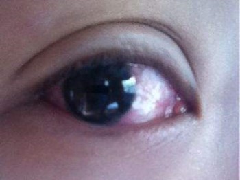 眼睛感染发炎怎么办，七大缓解方法  眼睛 怎么办 美白祛黄 第4张