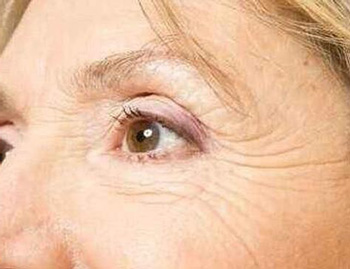 眼袋下垂怎么消除效果好，学会4种方法缓解  眼袋 美白祛黄 第2张