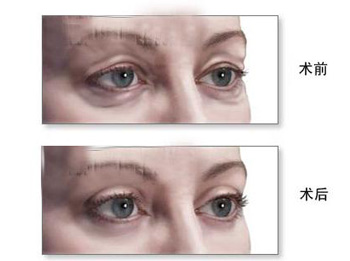 眼袋下垂怎么消除效果好，学会4种方法缓解  眼袋 美白祛黄 第4张