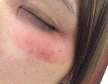 敷眼膜有刺痛感**辣这是为什么  眼膜 刺痛 美白祛黄 第2张