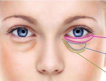 去眼袋手术有什么风险和危害  去眼袋 风险 美白祛黄 第2张