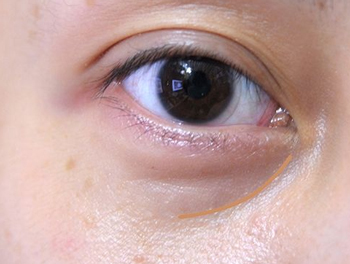 泪沟型黑眼圈怎么去除，教你正确去除假性黑眼圈