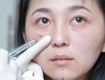 泪沟型黑眼圈怎么去除，教你正确去除假性黑眼圈  黑眼圈 泪沟型 美白祛黄 第2张