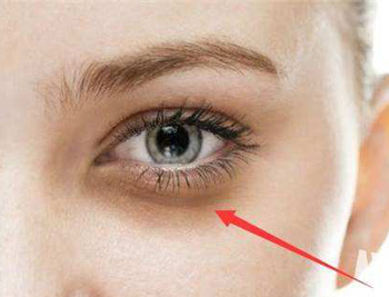 眼袋发黑是身体哪不好，必须知道的4种