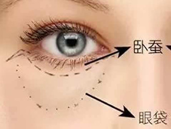 最先进的去眼袋方法，对比分析5种  去眼袋 美白祛黄 第5张