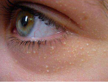 眼膜和面膜可以一起敷吗，眼膜的正确使用方式  眼膜 面膜 美白祛黄 第2张