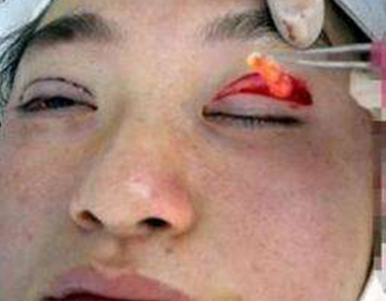 双眼皮热敷的正确方法，教你热敷正确消肿