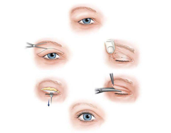双眼皮热敷的正确方法，教你热敷正确消肿  双眼皮 热敷 美白祛黄 第2张