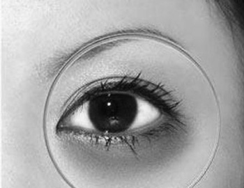 激光去黑眼圈有什么伤害，必须了解的5种  黑眼圈 激光 美白祛黄 第2张