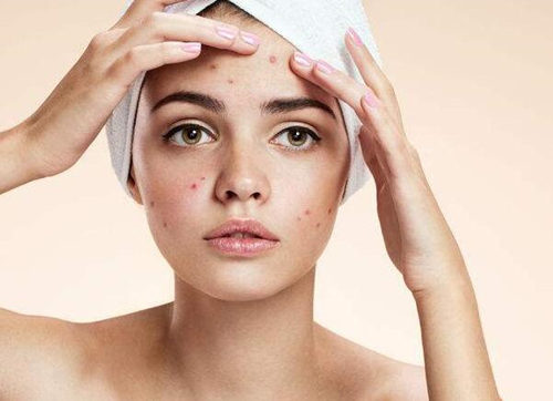 痘痘皮肤晚睡前如何保养，这几步非常关键