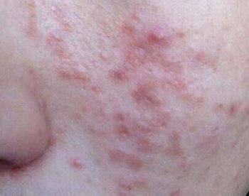 吃异维a酸皮肤会变好吗，有副作用吗  异维a酸 美白祛黄 第2张