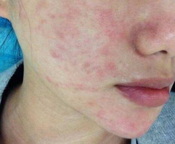 吃异维a酸皮肤会变好吗，有副作用吗  异维a酸 美白祛黄 第3张