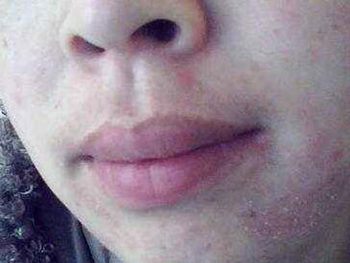 吃异维a酸皮肤会变好吗，有副作用吗  异维a酸 美白祛黄 第4张