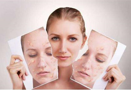 敏感痘肌如何有效祛痘无**，一位六年痘敏史小仙女忠告  敏感 痘肌 美白祛黄 第9张