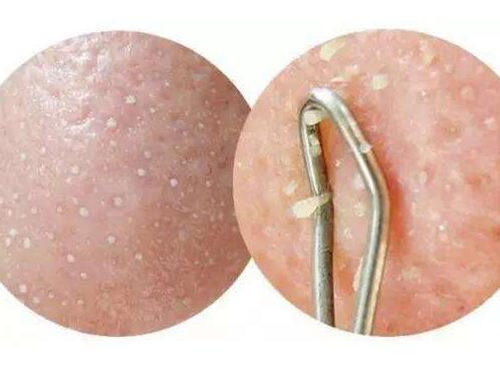 阿达帕林凝胶去粉刺得多久，使用注意事项要谨记  凝胶 阿达帕林 粉刺 美白祛黄 第2张