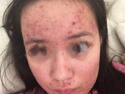 粉刺挑完多久才能好，怎么消除红肿