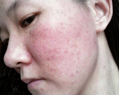 粉刺挑完多久才能好，怎么消除红肿  粉刺 红肿 美白祛黄 第2张