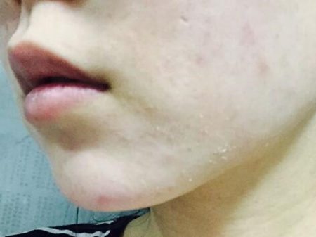 干性皮肤为什么会长痘，怎么办